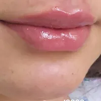 تزریق ژل و بوتاکس با تخفیف ویژه بهاری*|خدمات آرایشگری و زیبایی|جوانرود, |دیوار