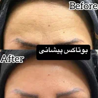بوتاکس توسط پزشک جهت رفع چین و چروک و لیفت ابرو|خدمات آرایشگری و زیبایی|یزد, |دیوار