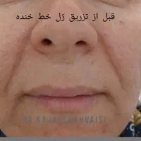 تزریق ژل بوتاکس مزوتراپی وجوانساز در مطب خانم دکتر