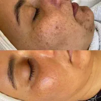 آموزش و خدمات تکنیک پوست مار و مزونیدلینگ|خدمات آرایشگری و زیبایی|اسلام‌شهر, باغ فیض|دیوار