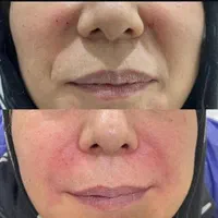 مطب پزشک ژل لب گونه چونه زاویه فک بوتاکس فیلر بینی|خدمات آرایشگری و زیبایی|قم, صفائیه|دیوار