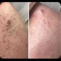 پاکسازی تخصصی  پوست|خدمات آرایشگری و زیبایی|دهدشت, |دیوار