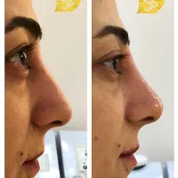 تزریق آنزیم و فیلر بینی|خدمات آرایشگری و زیبایی|تهران, پاسداران|دیوار