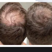 ترمیم وتراکم موهای آسیب دیده پی ار پی مزو900