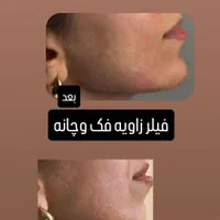 تزریق ژل وبوتاکس با بهترین قیمت در برازجان|خدمات آرایشگری و زیبایی|برازجان, |دیوار