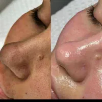 تخفیفات جشنواره فشیال و پاکسازی تخصصی پوست