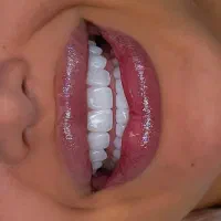 خدمات دندانپزشکی (ایمپلنت) با شرایط ویژه