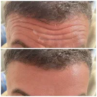 تخفیفات ویژه بوتاکس مزوتراپی مزوژل فیلر توسط پزشک