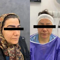 فرصت ویژه و محدود کاشت ابرو|خدمات آرایشگری و زیبایی|رشت, گلسار|دیوار