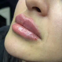 تزریق ژل وبوتاکس و آموزش فیلر با 5سال سابقه کاری|خدمات آرایشگری و زیبایی|جیرفت, |دیوار