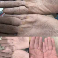 درمان اگزما