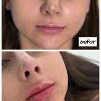 تزریقات ژل و بوتاکس