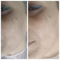 لک جوش و منافذ و جای جوش و لیفت و جوانسازی صورت|خدمات آرایشگری و زیبایی|زاهدان, |دیوار