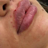 اف فیلرلب گونه چونه زاویه فقط 649|خدمات آرایشگری و زیبایی|محمدیه-قزوین, |دیوار
