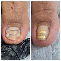 درمان ناخن های اسیب دیده پا