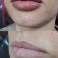 تزریق فیلر و بوتاکس|خدمات آرایشگری و زیبایی|قرچک, مهدیه|دیوار