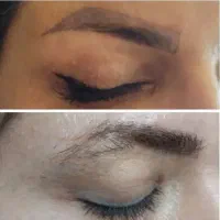 ریموو تتو تک جلسه ای|خدمات زیبایی و سلامت|کرمانشاه, |دیوار