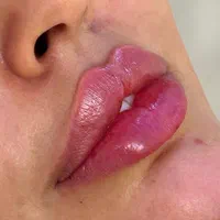 آموزش و تزریق ژل و بوتاکس