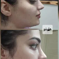 کلینیک لیفت جوانسازی هایفو سنندج (فیلربوتاکس)