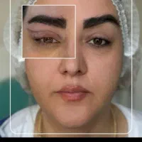 عمل پلک .بخیه  زیر پوست.پزشک متخصص چشم 15