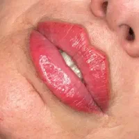 تخفیف فیلر برای این هفته800 نورامیس بوتاکس۱۲۰۰