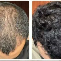 ورود کچلا ممنوع