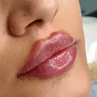 تزریق انواع بوتاکس  ژل آنزیم بینی نخ جوانسازی|خدمات آرایشگری و زیبایی|صدرا-فارس, فاز ۱|دیوار