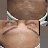 فشیال و پاکسازی و RF