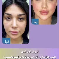 جشنواره فول فیس توسط پزشک متخصص|خدمات آرایشگری و زیبایی|تهران, ونک|دیوار
