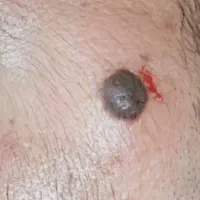 خال برداری و رفع کک ومک|خدمات آرایشگری و زیبایی|رشت, رودباری|دیوار