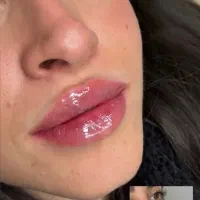 فیلرلب،بوتاکس چشم گربه ای،لیزر موی زائد،مزوژل