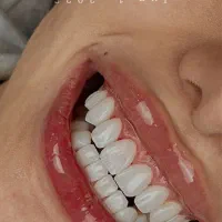 جشنواره بمناسبت روز مادر ایمپلنت، عصب کشی، جراحی،|خدمات آرایشگری و زیبایی|مشهد, شریف|دیوار