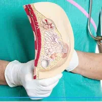 راهنمایی برای کیست سینه