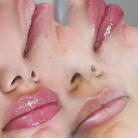 مرکز لیزر و زیبایی الماس.اندولیفت.بوتاکس.ژل لاغری|خدمات آرایشگری و زیبایی|اصفهان, شاهزید|دیوار
