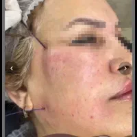 ژل لب وبوتاکس لیفت بانخ های قوی کشیدن پوست بینی و.