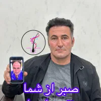 کاشت موپیش پرداخت ۳تومن تخفیف ویژه تعطیلات نوروزی