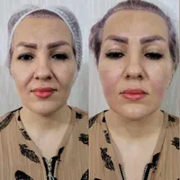 با هایفو ۱۰ سال جوانتر شو|خدمات آرایشگری و زیبایی|اهواز, زیتون کارمندی|دیوار