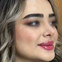 تزریق فیلر لب با متدهای ترند اینستا - دکتر واحدی