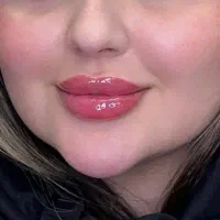جشنواره خدمات ژل فقط ۶۵۰ و بوتاکس فقط۷۰۰