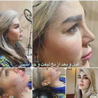 فیلربادی /کانتورینگ/ بوتاکس /فیلر لب
