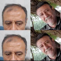 کاشت مو تخصصی
