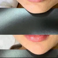 ژل و بوتاکس|خدمات آرایشگری و زیبایی|بم, |دیوار