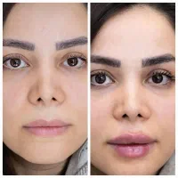 تزریق انواع بوتاکس ،ژل،مزوتراپی ،نخ.انزیم|خدمات آرایشگری و زیبایی|مشهد, سرافرازان|دیوار