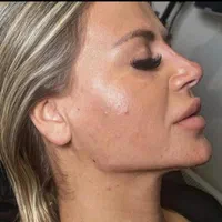 تخلیه چربی و تزریق به باسن