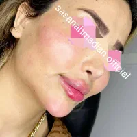 ژل و بوتاکس و مزوتراپی