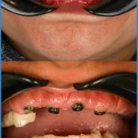 کلیه خدمات دندانپزشکی بابیهوشی با اقساط 12و24 ماهه