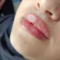 فیلر لب|خدمات آرایشگری و زیبایی|مشهد, رده|دیوار