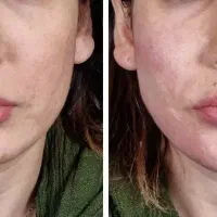 تزریق ژل و بوتاکس