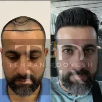 کاشت مو و ابرو در تهران (حتی اقساط)|خدمات زیبایی و سلامت|کرمانشاه, |دیوار