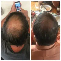 درمان ریزش مو ورشد مجدد مو|آرایشی، بهداشتی، درمانی|زنجان, |دیوار